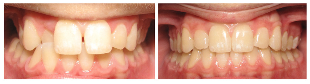 Comparison image of teeth before and after invisalign